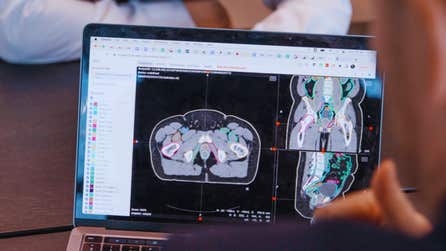 xMVision Contour+ AI contouring for radiation therapy
