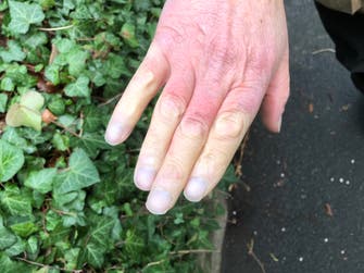 Male hand with Raynauds