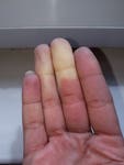 Woman's hand with Raynauds