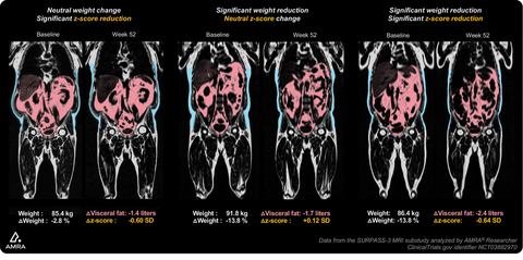 tirzepatide liver fat AMRA Medical's Innovative Fat Z-Score Biomarkers Show Tirzepatide Treatment  is Associated with a Potential Targeted Effect on Visceral Fat and Liver Fat