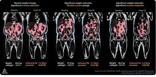 AMRA Medical's Personalized Fat Z-scores (Photo: Business Wire)