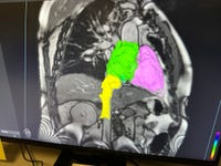 Imricor’s NorthStar Mapping System being used in the VISABL-AFL Procedure (Photo: Business Wire)