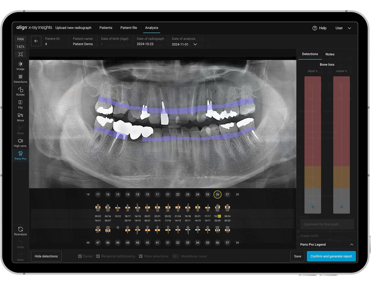 Align Technology Launches Align X-ray Insights, an AI Computer-Aided ...