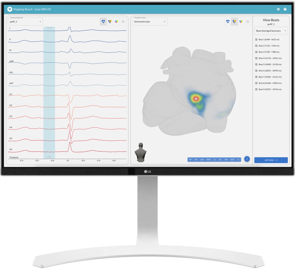 Vektor Medical Secures CE Mark for vMap, Bringing the Benefits of Non ...