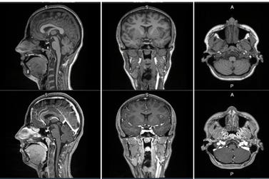 First-in-human contrast enhanced MRI images with GE HealthCare's mangaciclanol